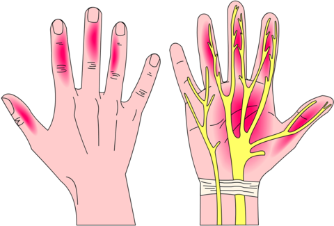 WHAT IS CARPAL TUNNEL SYNDROME?