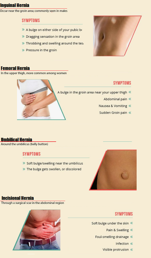 Type of hernia