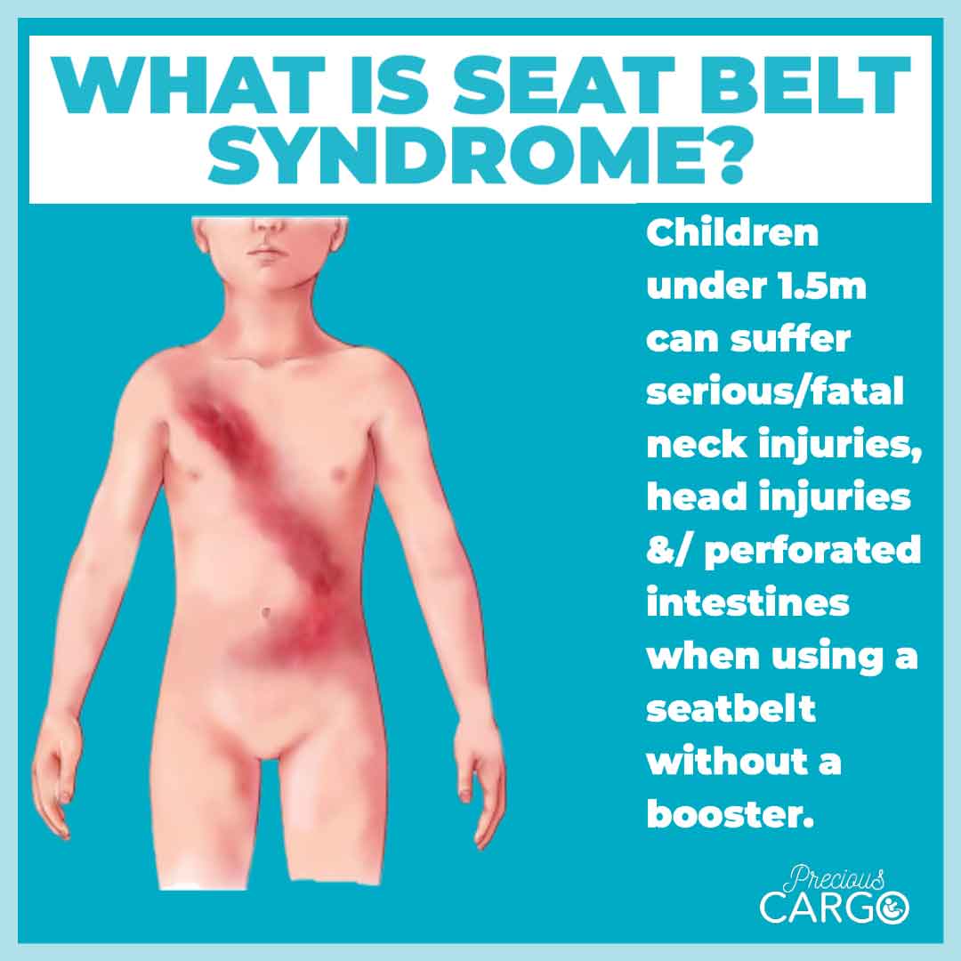 Seat Belt Syndrome