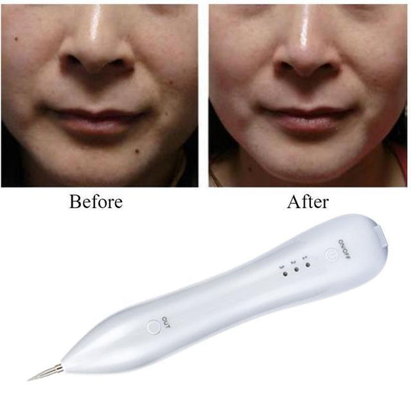 SpotEraser Pro™ - Remove Tag/Mole/Tattoo on Skin - 50% OFF ...