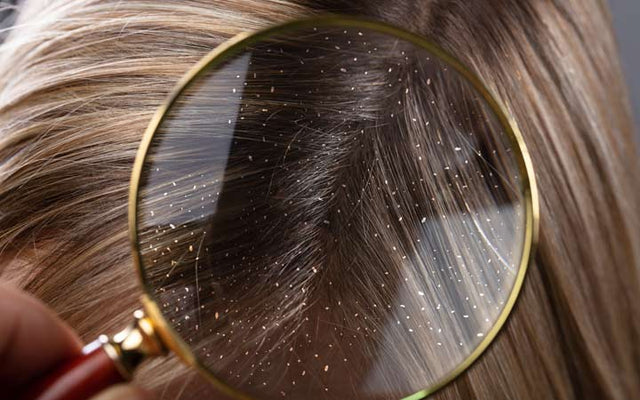 10 Hair Wash Tips To Reduce Dandruff  India CSR