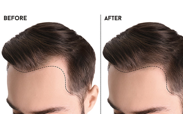 How To Tell If You Have A Receding Hairline   Evidence Based Baa9cfc6 8729 4c4b 8f4e 6ed6f9d58250 1024x400 