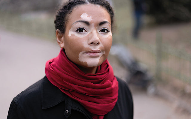 Vitiligo: Types, Symptoms, Diagnosis &amp; Treatments – SkinKraft