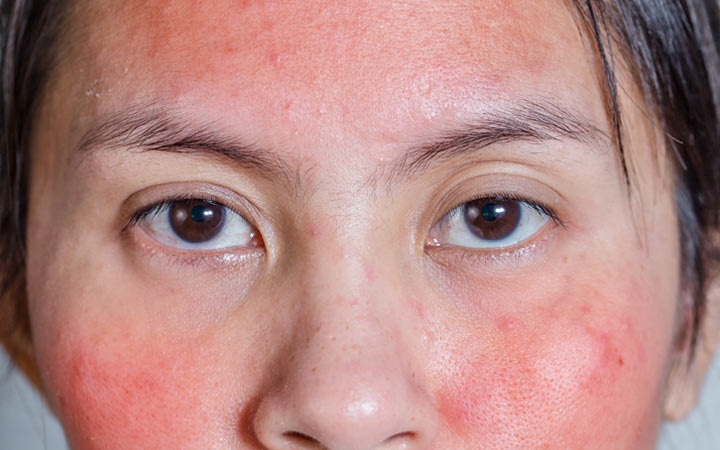 red-skin-rash-on-face