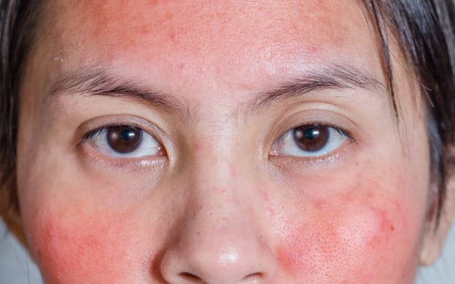 Redness On Face: Causes & 8 Ways To Reduce It – SkinKraft