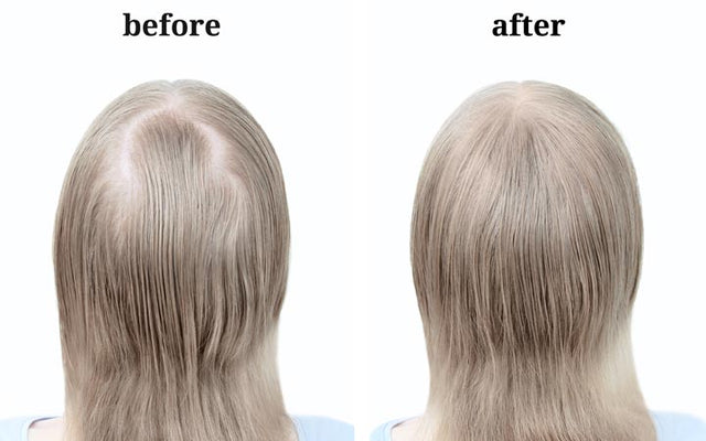 बल झडन कस रक  Hair fall treatment and remedies in Hindi   nirogikayacom