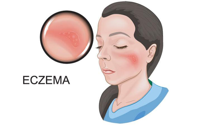 How To Treat Eczema Causes Symptoms Prevention 5 Different Types Skinkraft