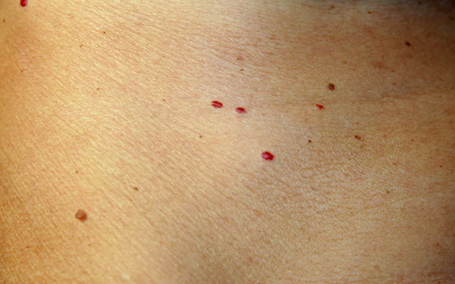 tiny pinpoint red spots on the skin