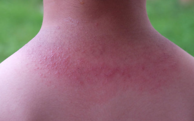 causes of rash purple