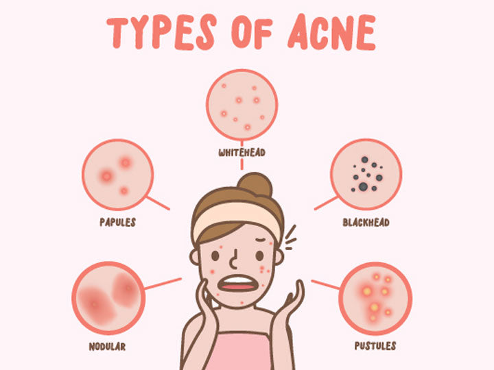 Types Of Acne Nodules