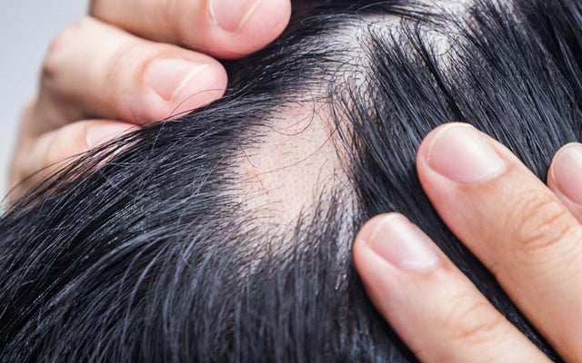 Balding Causes Symptoms And Treatments  SkinKraft