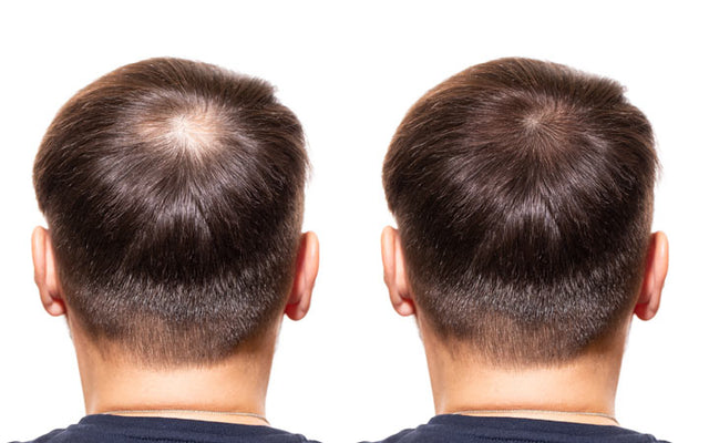 One male hair loss treatment works better than others study finds  CNN