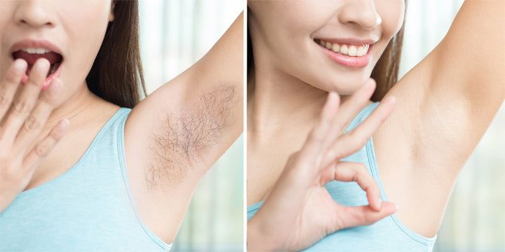 Laser Hair Removal Vs. Electrolysis: Which One Is Better For Your Skin –  SkinKraft
