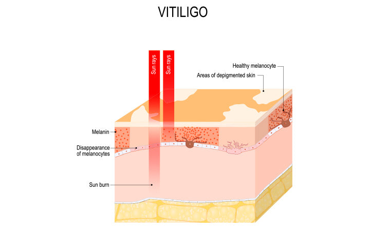 A Skin Condition Vitiligo