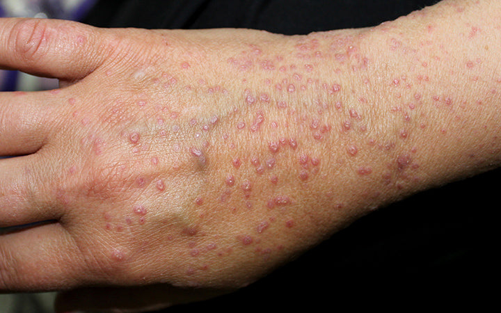 What Do Red Spots On Skin Mean? 13 Skin Spots & Bumps Pictures