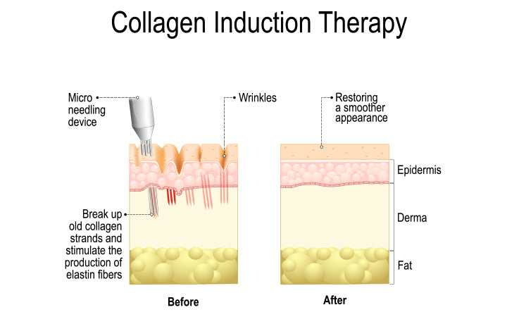 Before and after results of collagen induction therapy