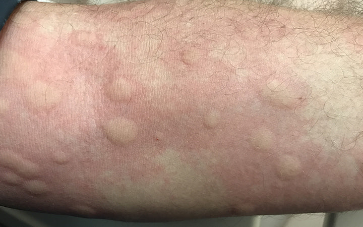 Body part showing urticarial rash from drug allergy
