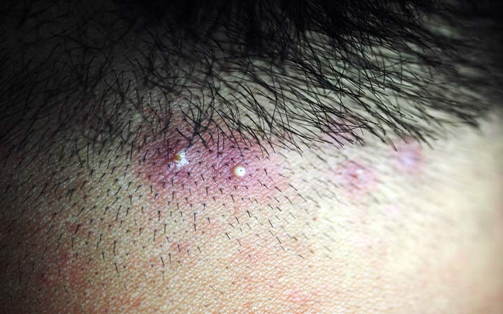 Inflamed pus pimples on head scalp