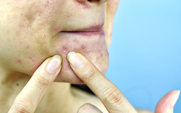 Close up photo of acne prone skin problem