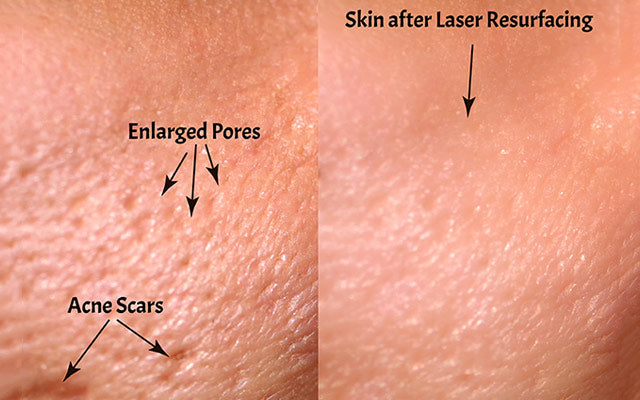 Comparison of skin before and after laser resurfacing