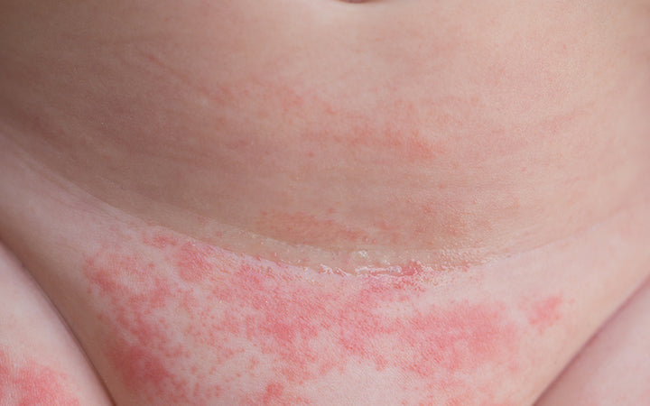 What Causes Red Spots On Skin How Them – SkinKraft