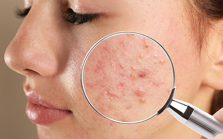 Girl With Acne on Face Visiting Dermatologist