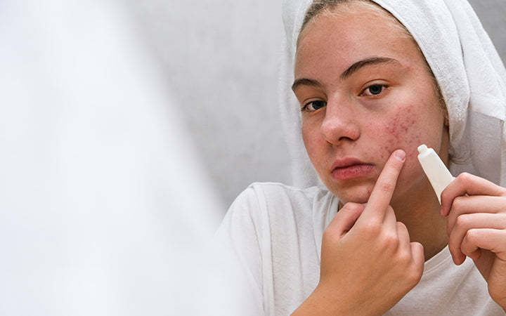 Girl applying acne medication on her face