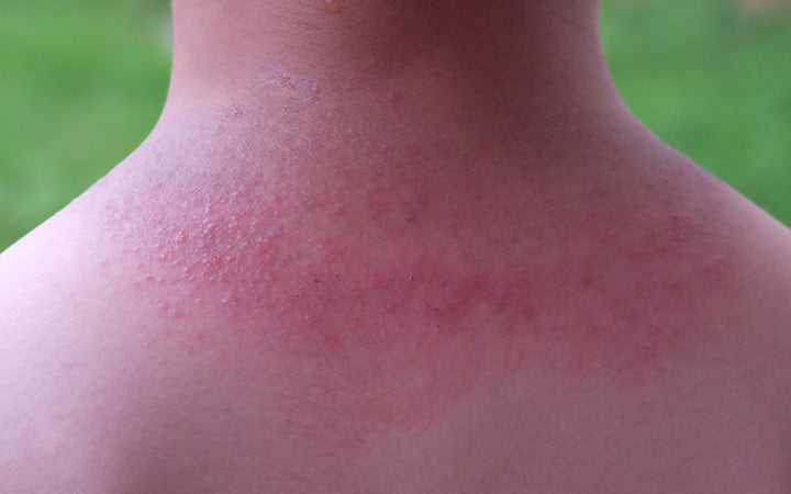 13 Causes of Red Spots on Skin
