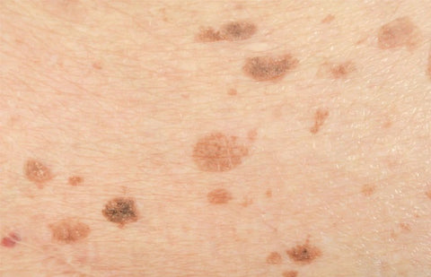 Brown Skin Spots - When not to worry about the brown spots on your