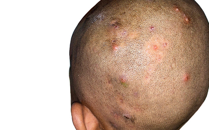 Numerous painful furuncles or boils and folliculitis on head.
