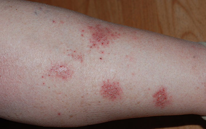 Nummular eczema on the leg