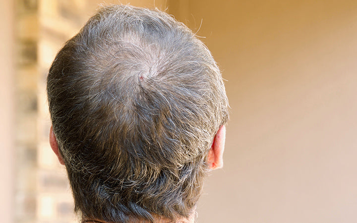 Ingrown Hair Cyst Symptoms Treatment Prevention  More