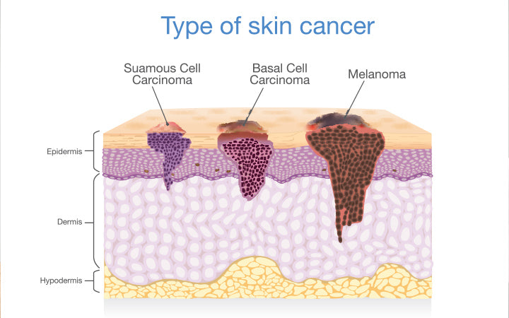 Skin layer have 3 Type of Cancer in one