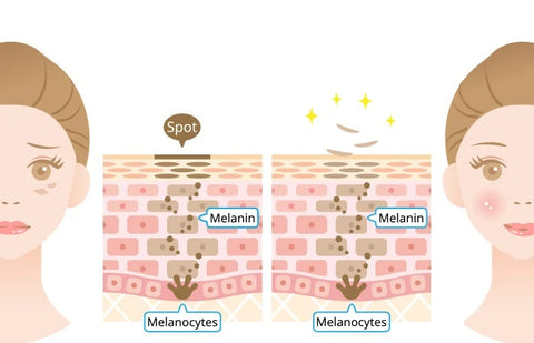 Dark Spots Causes Prevention Tips And Treatments Skinkraft