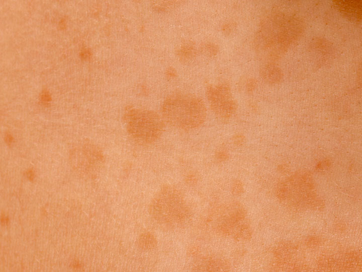 5 Types Of White Spots On Face And How To Manage Them Skinkraft