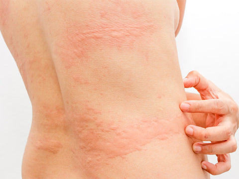Skin Rashes Types Treatment And Prevention Skinkraft