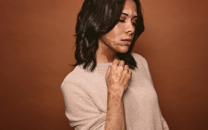 Vitiligo on a woman’s face and body as a result of pigment loss