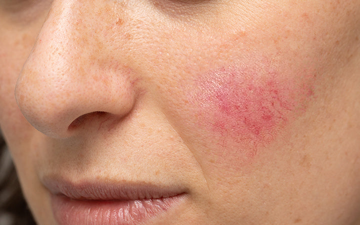 Woman with blotchiness on the cheek
