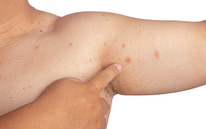 allergic rash dermatitis eczema skin of patient armpit