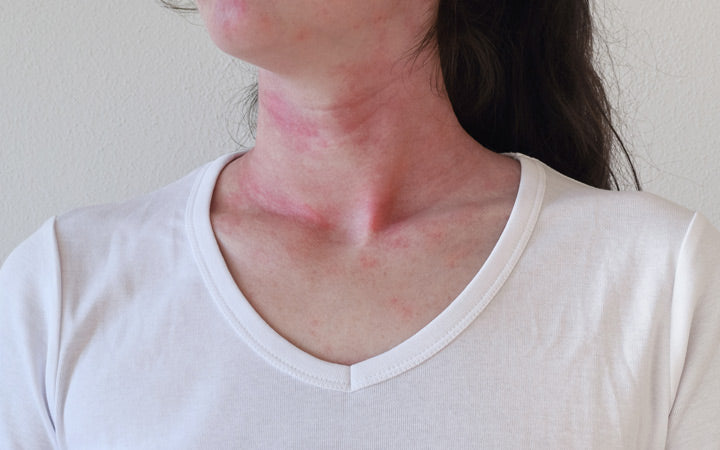 allergic skin reaction on female neck