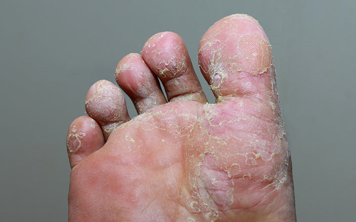 athlete's foot having fungal infection