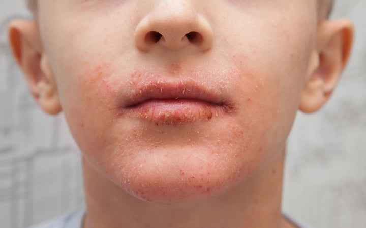 atopic skin on boy face allergic rash on face and lips