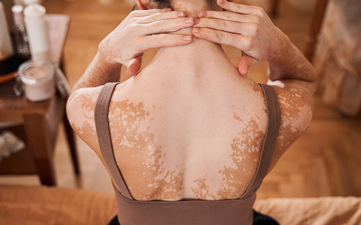 back view of woman with vitiligo skin applying cream