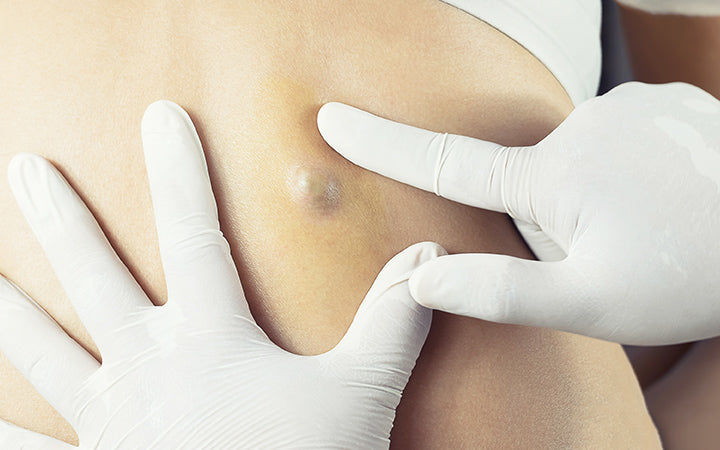 doctor diagnosis of the sebaceous on woman's back