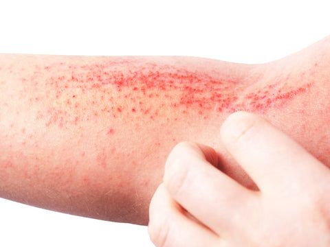 types of skin rashes that itch and spread