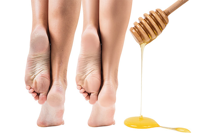 feet with dry skin before and after honey treatment