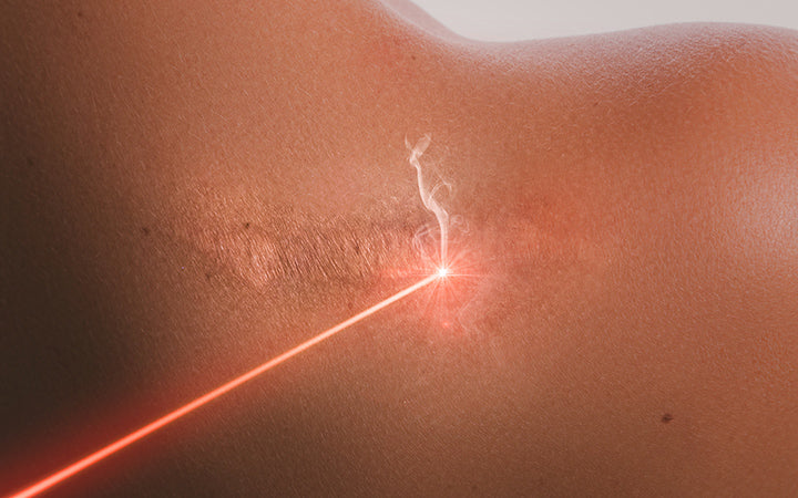 female shoulder and laser beam during scar removal treatment