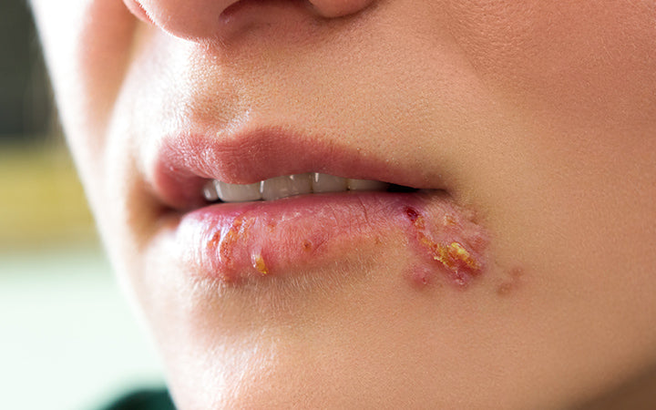 girls lips showing herpes