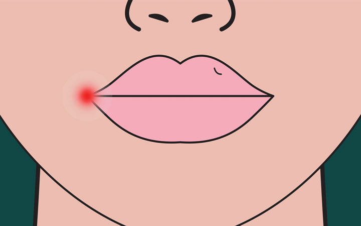 herpes on lip red inflammation on lip of woman