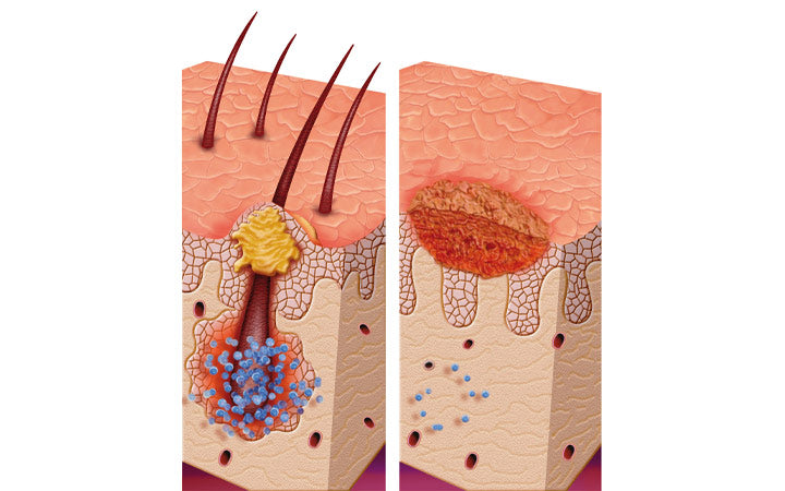 illustration about foliculis skin